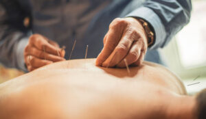 acupunture